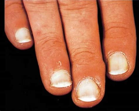 leukonychia definition|nail problems and vitamin deficiencies.